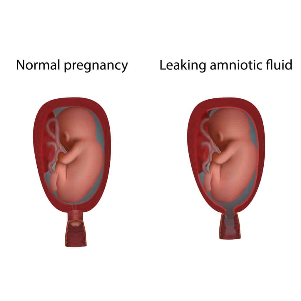 World Prematurity Day: Preterm delivery due to leaking of amniotic fluid