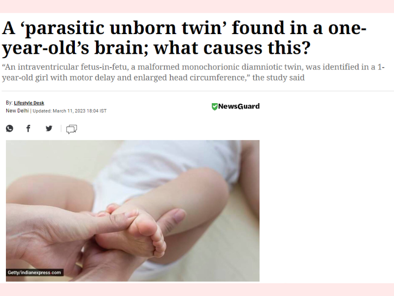 Rare case: Parasitic twin in child's brain - Motherhood Hospital India.